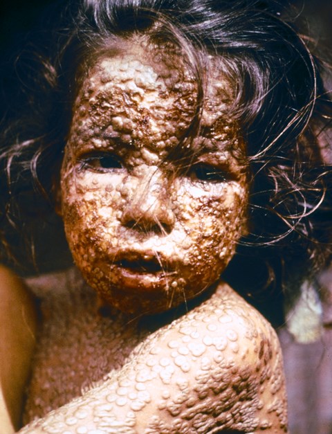 Child_with_Smallpox_Bangladesh